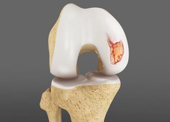 Knee Cartilage Preservation and Repair